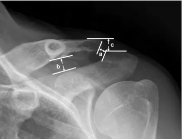Table 2. Clinical Outcomes of K-wire Transfixation and Locking Hook Plate  Fixation Groups Variable K-wire   (n=56) Locking hook  plate (n=21) p-value Age (yr)  36.4 (17–69) 34.8 (20–54) 0.632 Sex (male/female) 53/3 21/0 0.558