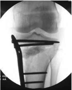 Fig. 2. Intraoperative fluoroscopy which shows periartic- periartic-ular distal tibia locking plate with allo-bone graft.
