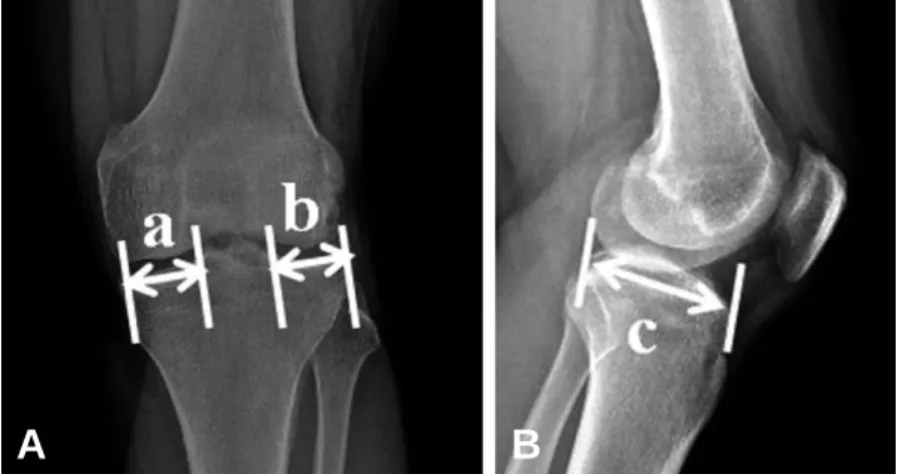 Fig. 2. The size of allograft is measured using the magnification controlled plain radiographs