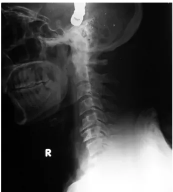 Fig. 2. X-ray cervical spine lateral view of the same patient showing  the alignment of the cervical spine with reduction of the retropulsed  C7 body after application of cervical tongs with adequate weights  at-tached.
