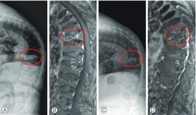Fig. 1. (A, B) A 74-year-old female’s simple radiograph and magnetic resonance imaging (MRI) demonstrating acute osteoporotic  compression fracture in T12, multiple old compression fractures, and resultant kyphosis