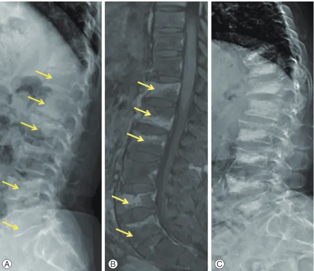 Fig. 2. (A, B) A 72-year-old female’s simple lateral X-ray and magnetic resonance imaging showing multiple acute compression  fracture