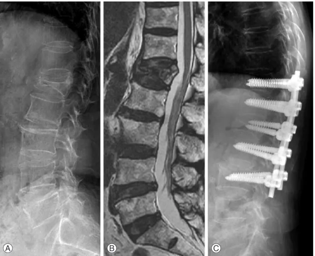 Fig. 3. (A, B) A 74-year-old female’s simple X-ray and magnetic resonance imaging demonstrating acute osteoporotic compression  fracture in L1 and resultant kyphosis