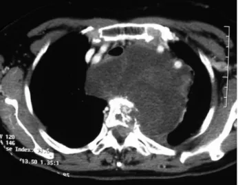 Fig. 3. A 30 -day postoperative chest X-ray showing surgical results  with placement of a vertebral mesh and application of a long thoracic  plate.