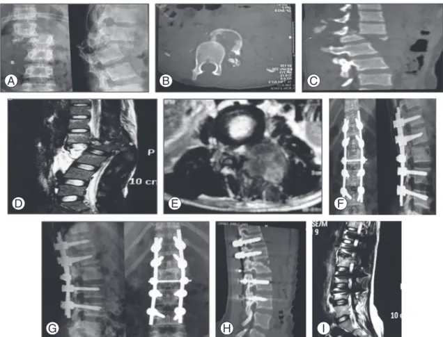 Fig. 3. L1/L2 fracture dislocation in a 35-year-old female as a result of fall of a heavy object while doing agriculture work