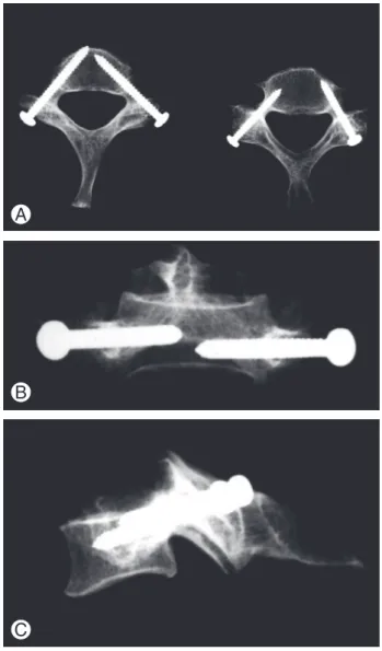 Fig. 7. (A–C) Different X-ray views of the cervical pedicle screws in  place.