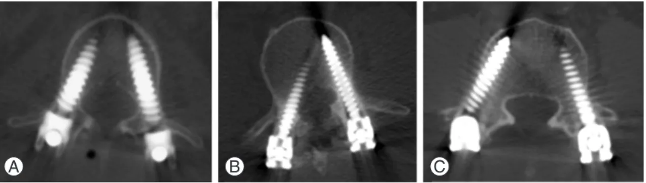 Fig. 1. Postoperative computed tomography images show the relationship between the pedicle and the screw