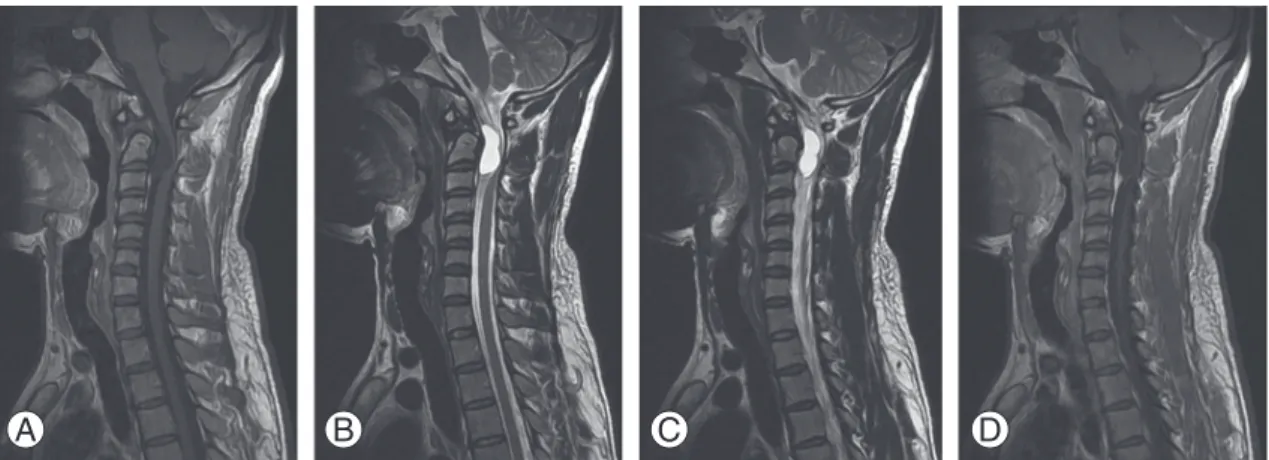 Fig. 2. Magnetic resonance imaging cervical spine sagittal images showing an isointense lesion on the T1W image (A), becoming  hyperintense on T2W (B) and fluid-attenuated inversion recovery sequence images (C), with peripheral rim of enhancement after  co