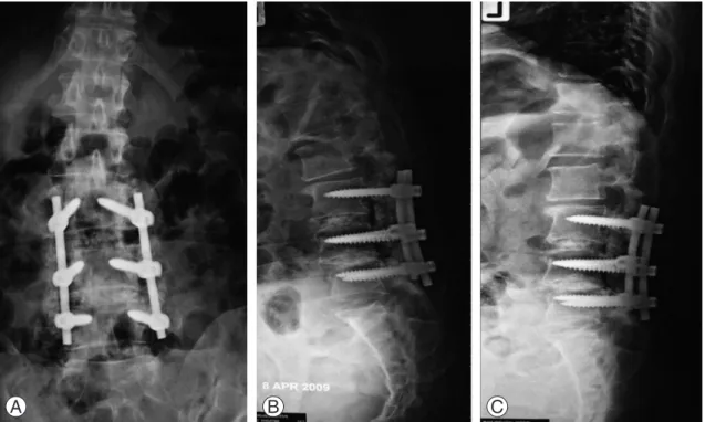 Fig. 3. (A) A 49-year-old female patient, 6 months after transpedicular screw insertions and transforaminal lumbar interbody fu- fu-sion at L3−L4−L5 showed bilateral trabecular bone bridge at L4−L5 space on anteroposterior plain film
