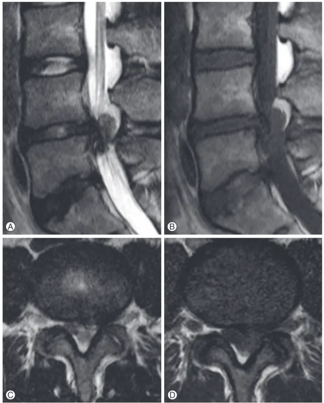 Fig. 3. T1 - and T2-weighted magnetic resonance imaging (MRI) showed the lesion in the posterior epidural space at L4−5