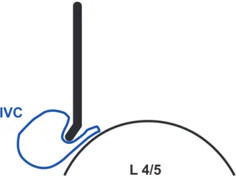 Fig. 4. Diagram illustrating suboptimally placed retractor which is  compressing part of vena cava circumference and not safely  retract-ing it