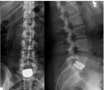 Fig. 2. Lumbar spine antero-posterior and lateral X-ray views showing  optimal positioning of the prosthesis.