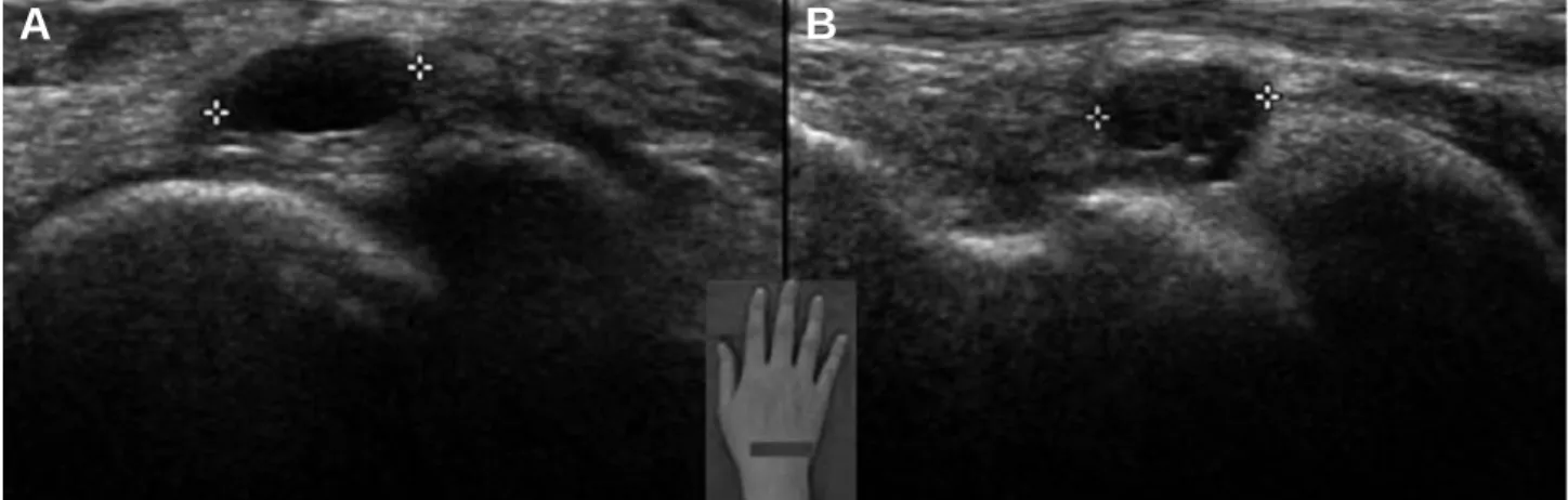 Fig. 1. (A) Transverse image shows tenosynovitis at the 1st extensor compartment of the tendons and multiple slips of abductor pollicis longus tendon