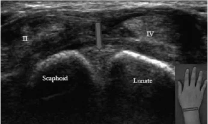 Fig. 4. Twenty years old man complained persistent pain after receiving blow on the wrist a ear ago