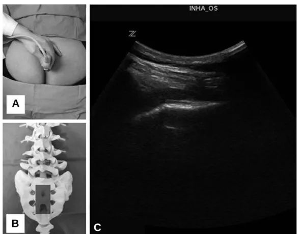 Fig. 3. The needle insertion into caudal epidural space.