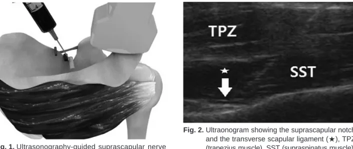Fig. 1. Ultrasonography-guided suprascapular nerve block provides optimal imaging at the longitudinal plane.