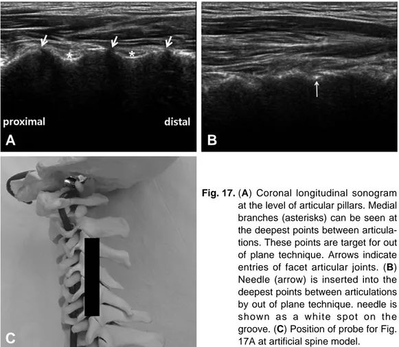 Fig. 17. (A) Coronal longitudinal sonogram at the level of articular pillars. Medial branches (asterisks) can be seen at the deepest points between  articula-tions