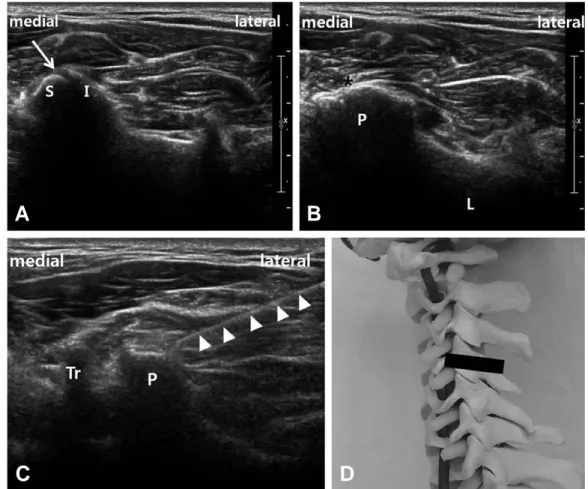 Fig. 18. (A) Initially achieve transverse sonogram at the level of targeting facet joint