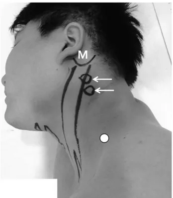 Fig. 3. Surface anatomy of lateral neck region. Below mastoid process (M), articular pillars (arrows) can be palpated