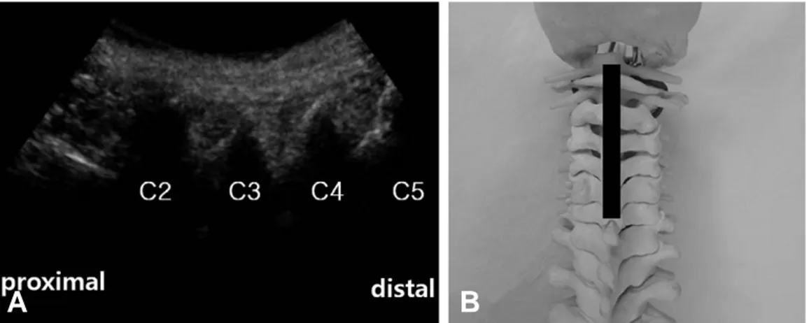 Fig. 5. (A) Ultrasonography on posterior longitudinal paravertebral sonogram shows laminae of cervical spines.