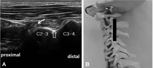 Fig. 12. (A) Lateral longitudinal sonogram below mastoid process (arrow) shows transverse processes of C1 (taller and wider) and C2