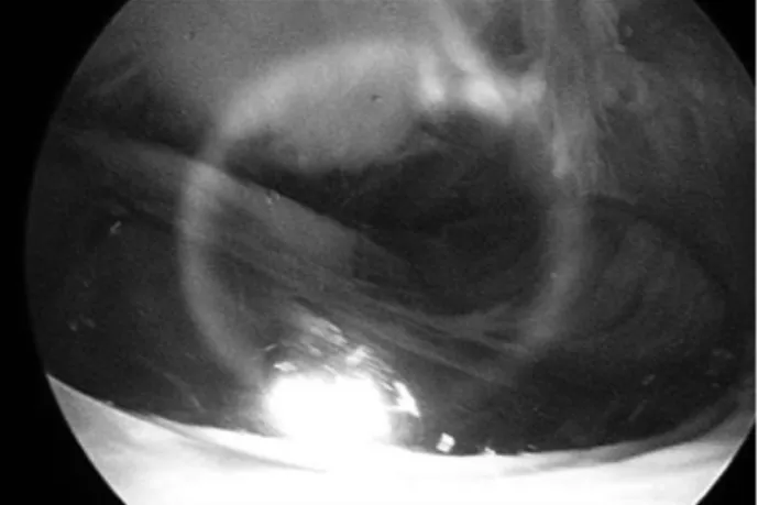 Fig. 5. Arthroscopic finding of the procedure removing the fibrous nodule with arthroscopic shaver.