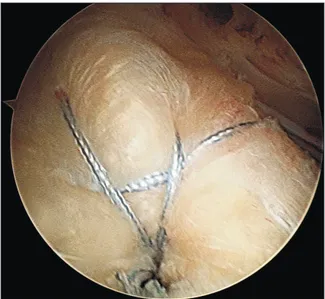 Fig. 2. An arthroscopic subacromial view shows the mattress locking  suture configuration after inserting an anchor.