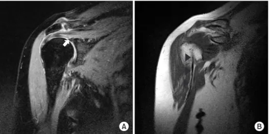 Fig. 4. (A) The oblique coronal view of  magnetic resonance imaging of the non­