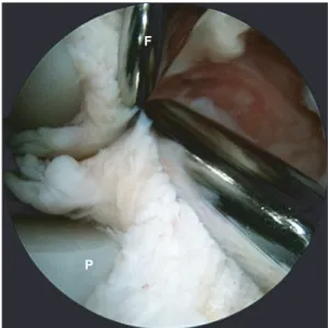 Fig. 2. An arthroscopic view of the medial compartment during  dynamic evaluation shows hypertrophic fibrous tissue that is trapped  between the femoral components and the polyethylene insert during  flexion of the knee from an extension position