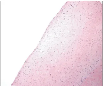 Fig. 4. A histologic examination shows degenerated fibrous tissue with  an attenuated synovial cell (H&amp;E, ×100).