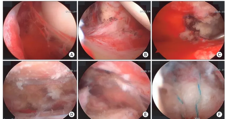 Fig. 1. (A) After manipulation, arthroscopic findings showed hemarthrosis and inflammation of the shoulder joint