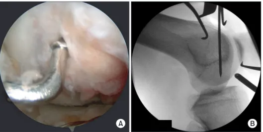 Fig. 3. (A) Femoral socket center was  placed 3-4 mm posterior to the articular  junction and at an 11 o’clock angle (in  the left knee)