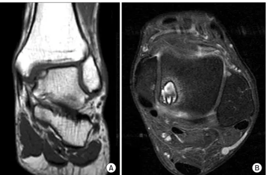 Fig. 1. Magnetic resonance imaging  finding of osteochondral lesion of talus   (OLT). (A) Coronal view shows osteo chon­