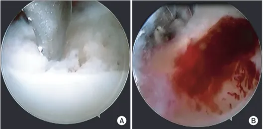 Fig.  2.  Arthroscopic  finding  shows  microfracture procedure using a micro­