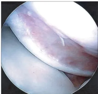 Fig. 1. Arthroscopic view of the large­sized Hill­Sachs lesion.
