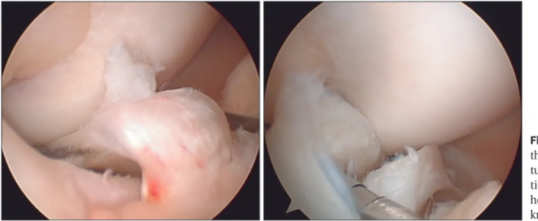 Fig. 4. The tear is located across zones B and C according to the  classification system established by Cooper et al