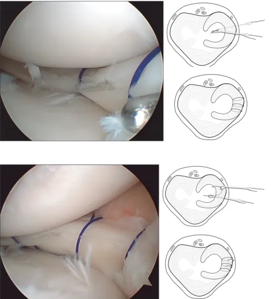 Fig. 6. For the vertical repair, the meniscus  was pierced vertically using a suture  hook and a No.0 PDS suture