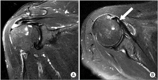 Fig. 2. Arthroscopic findings of patients who exhibited a combined partial tear of the upper subscapularis