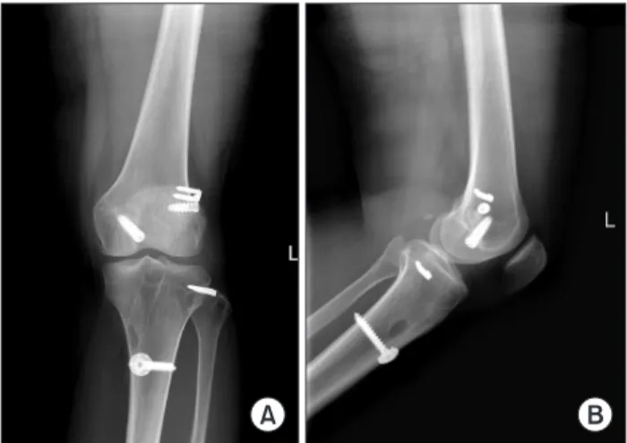 Fig. 2. X-ray at 2 years postoperation showing implants that were used  for reconstructing the posterior cruciate ligament and the posterolateral  ligament complex in the left knee (anteroposterior (A) and lateral (B)  radiography).