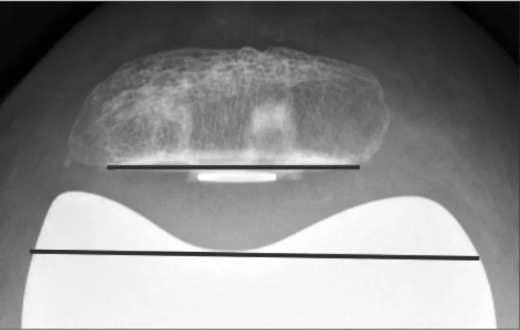 Fig. 2. Maximal flexion is the angle between lines drawn through mid- mid-points of soft tissue of the thigh and calf on the lateral radiograph of the  actively flexed knee.