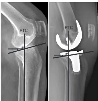 Fig. 1. Preoperative and postoperative radiographs showing the methods  of determining posterior tibial slope