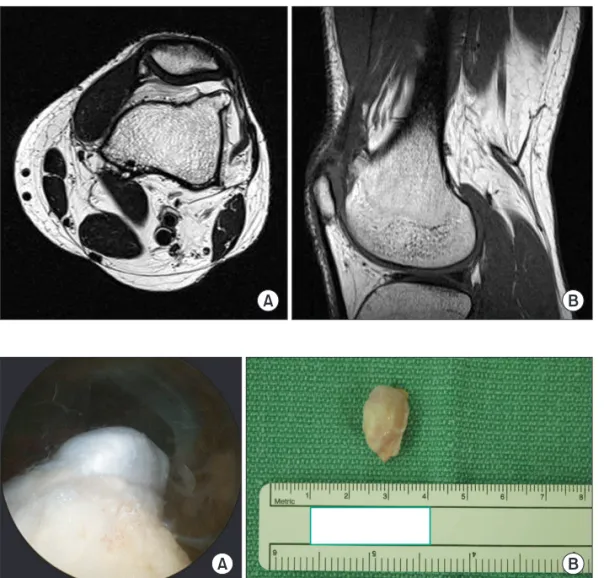 Fig. 3. (A) Arthroscopic superolateral view  shows the intra-articular cartilagenous cap  of the knee joint