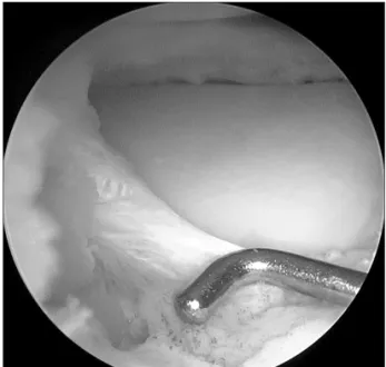 Fig. 6. The remaining 6 mm rim on overall meniscus could be conform- conform-ed using 5 mm arthroscopic probe.