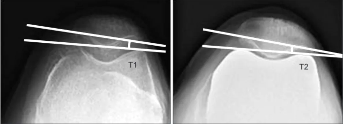 Fig. 3. The angle between the mechanical axis of the femur and the  anatomical axis (α angle)