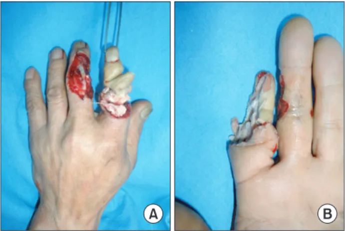 Fig. 3. Intraoperative view. Index finger soft tissue as heterodigital  free fl ap for the coverage of long fi nger defect.