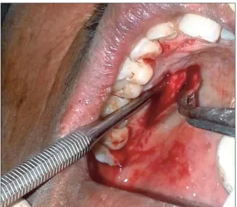 Fig. 5. Suturing of connective tissue graft on the denuded root surface. 