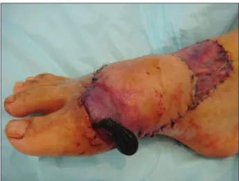 Fig. 5. Schematic design of the flap. DPA: dorsalis pedis artery, STSG: 