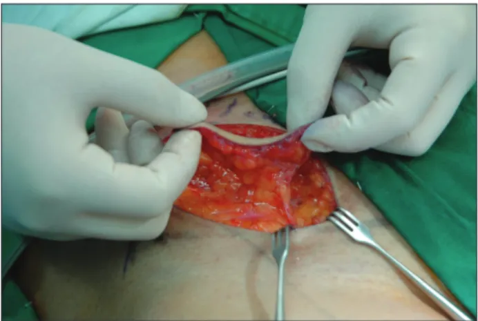 Fig. 3. Design of superficial circumflex iliac artery perforator free flap  on inguinal area
