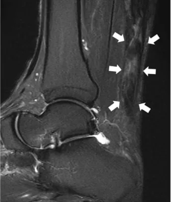 Figure 1. Thickened Achilles tendon with diffuse intratendinous heterogenous-signal change on T2 MR image.