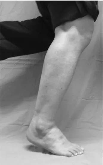 Figure 7. This patient is able to perform a single limb heel rise on the right leg.